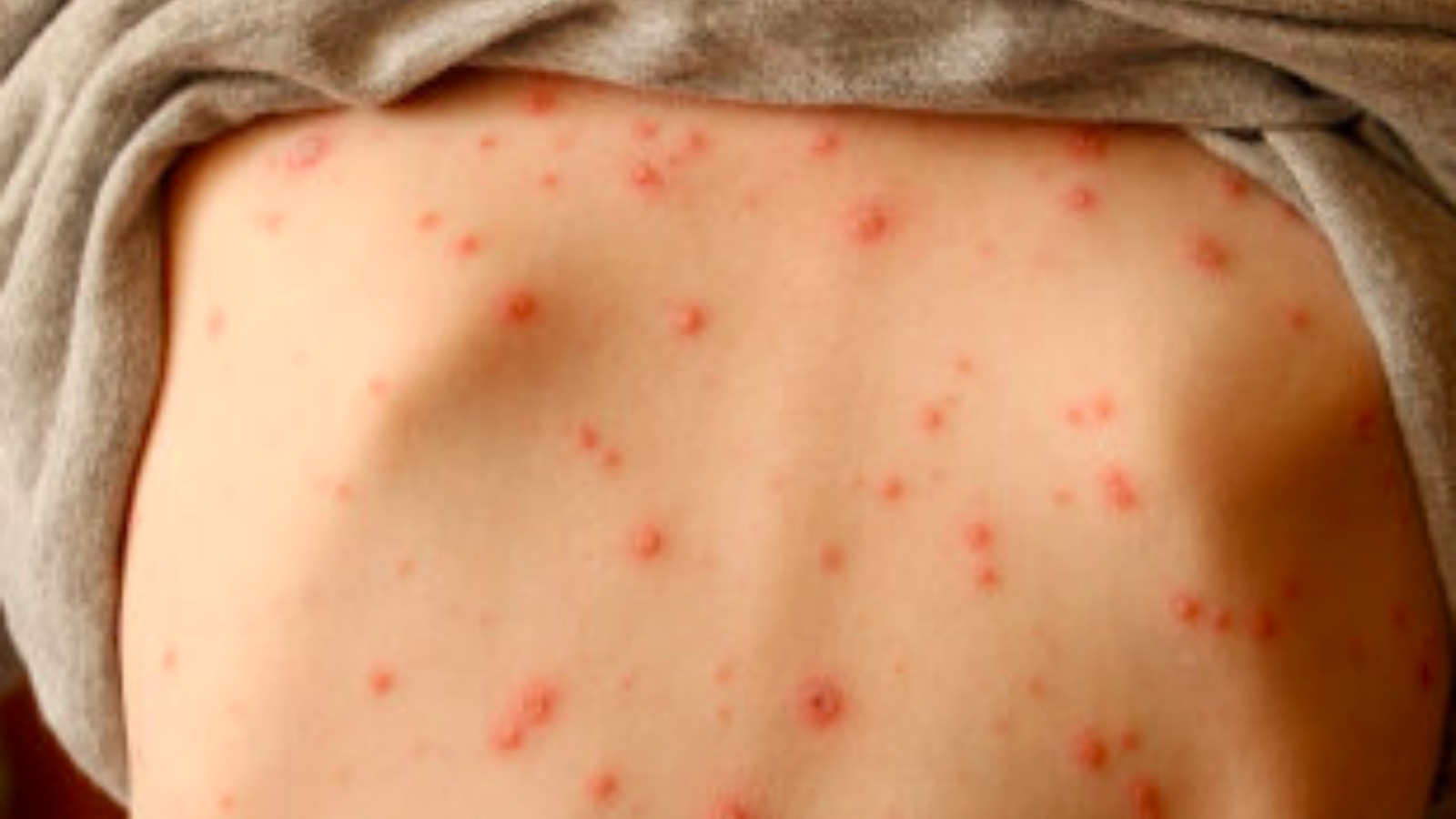 pics of chickenpox