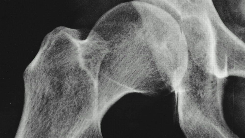 Report Substandard hip and knee replacements being licensed for use