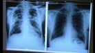 Lung Cancer