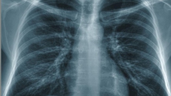 Lung Cancer