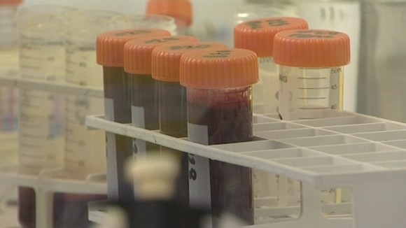 Cambridge University drug could help those with MS