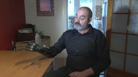 Nigel Ackland has a bionic arm