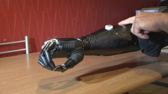 Nigel lost his hand in an industrial accident six years ago