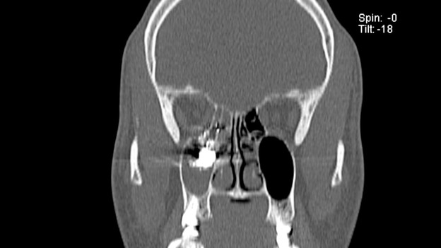 A team of surgeons from the Queen Elizabeth Hospital and the BMI Hospital Birmingham removed the bullet through Ummad's nose