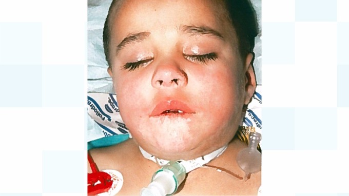 Ayman suffered severe burns to his mouth, airway, oesophagus and stomach