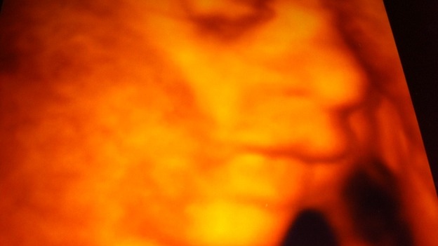 4D ultra sound picture of Abigail