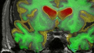 Dementia brain scan