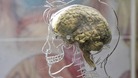 Alzheimer's