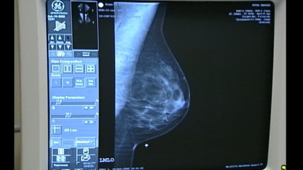 At risk women could get preventative breast cancer drugs 