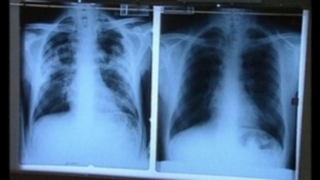 lung xray
