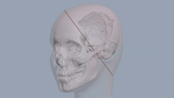 This illustration shows where the bullet entered and exited Malala's head