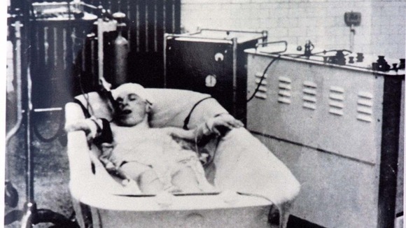 An undated picture of a patient at Papworth Hospital in a bath of cold water before heart surgery