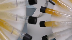 No more sending samples to the lab - now you can test your urine on your smartphone
