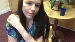 24-year-old Claire Shortland started self-harming as a teenager