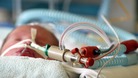 A premature baby