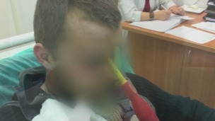 A Polish man, with his identity concealed, is seen with the screwdriver in his head