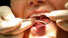 The findings are published in the latest issue of the Journal Of Dental Research.