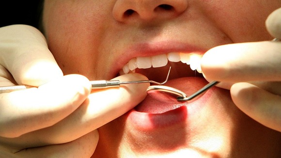 The findings are published in the latest issue of the Journal Of Dental Research.