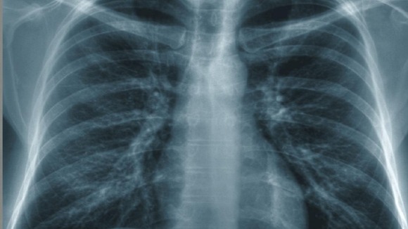 Lung cancer rates in women