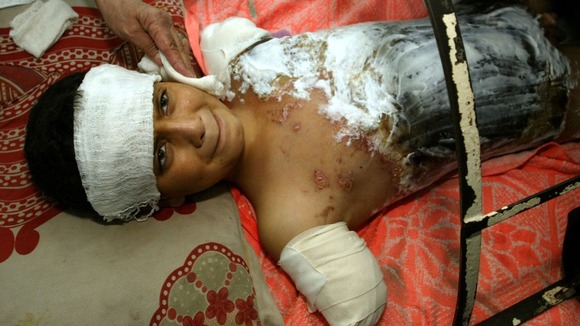 Ali Abbas lies in a hospital bed in Baghdad, April 6, 2003. Ali Abbas lies in a hospital bed in Baghdad, April 6, 2003.