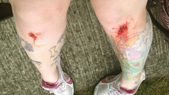 Emily Alner sent ITV News an image of the injuries she sustained from the emergency landing