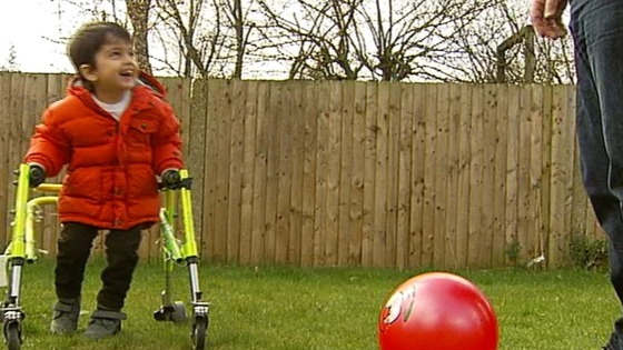 Xavier Fane could walk un-aided after the pionerring surgery