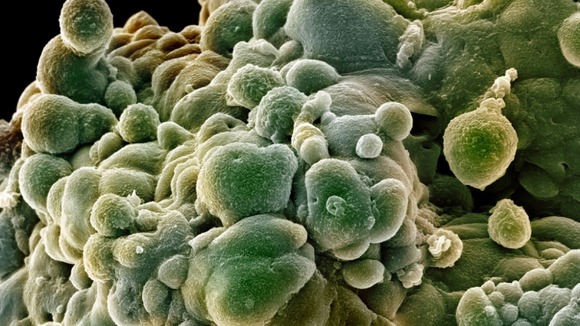 Prostate cancer cells