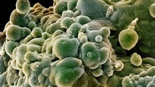 Prostate cancer cells