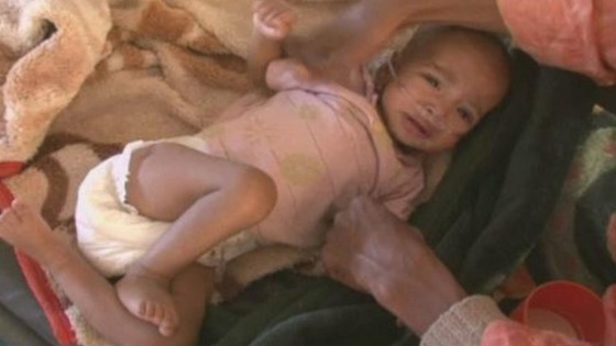 A baby is treated in the desert refugee camp in Mbera, Mauritana. 