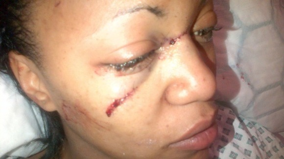 Lasha Horton says her modelling career is over after being told she is scarred for life.