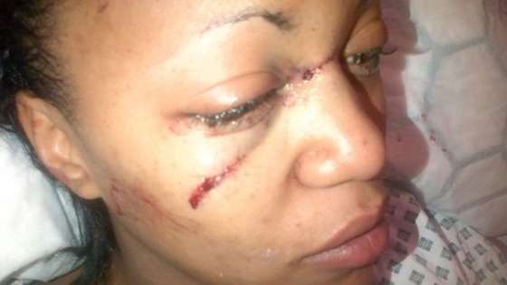 Lasha Horton says her modelling career is over after being told she is scarred for life.