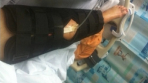 Jake Weir's injured leg.