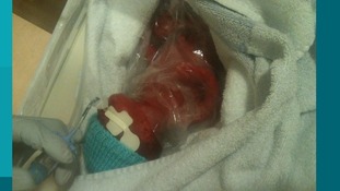 Demi Bloomfield was born three and a half months early and weighed just 1lb 6oz