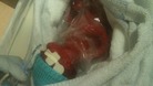 Premature baby Demi defies the odds