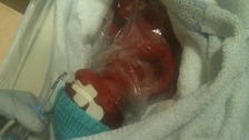 Premature baby Demi defies the odds
