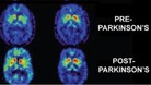 Common diabetes drug could treat Parkinson's disease
