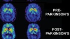 Common diabetes drug could treat Parkinson's disease