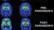 Common diabetes drug could treat Parkinson's disease