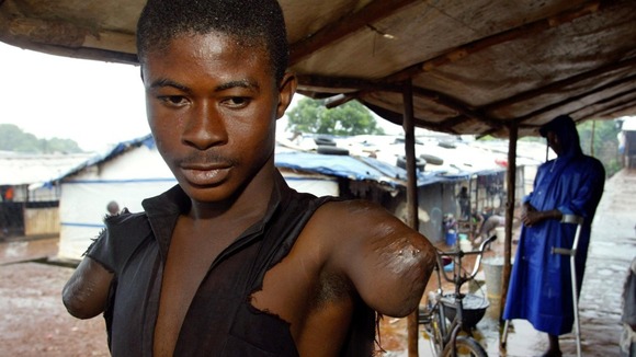A young man with his arms amputated in a refugee camp in Freetown in 2003