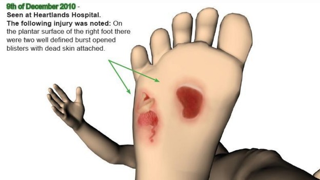 A police image illustrating some injuries identified on Keanu Williams' foot in December 2010.