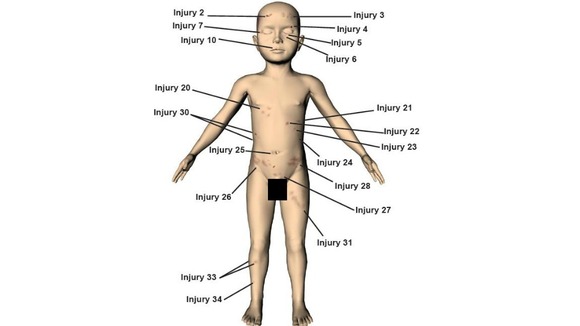 A police image illustrating some of the 37 injuries identified on the body of Keanu Williams.