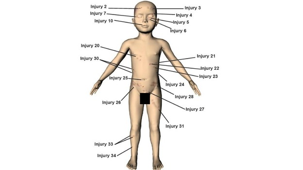 A police image illustrating some of the 37 injuries identified on the body of Keanu Williams.