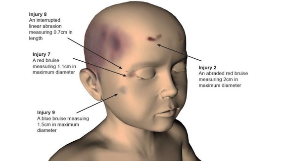 A police image illustrating some of the injuries identified on Keanu Williams.