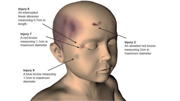 A police image illustrating some of the injuries identified on Keanu Williams.