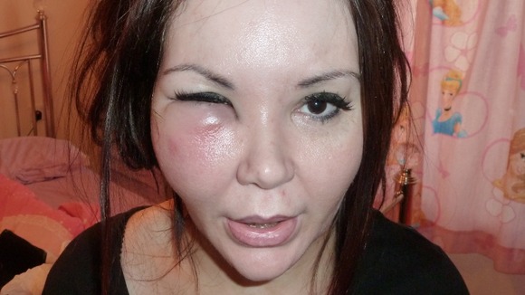 Young lady CU with very swollen cheek