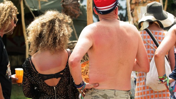 Festival-goers with sunburn on their back at the Glastonbury Festival,