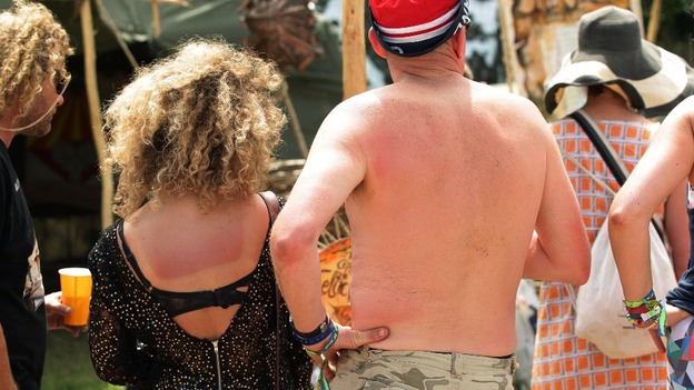 Festival-goers with sunburn on their back at the Glastonbury Festival,