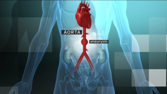 An aneurysm within the aorta