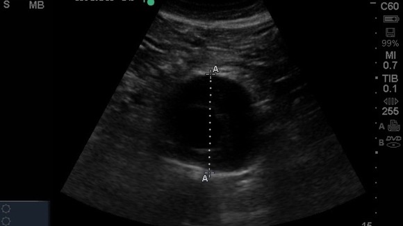A scan showing an aorta with an aneurysm