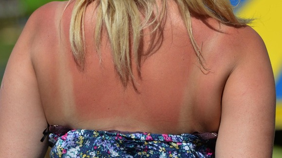 Prevention is better than cure when it comes to sunburn.